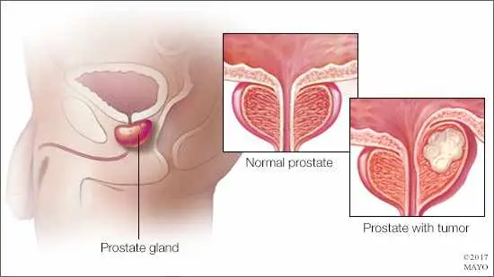 Prostate Adenoma and Long Trips in Transport